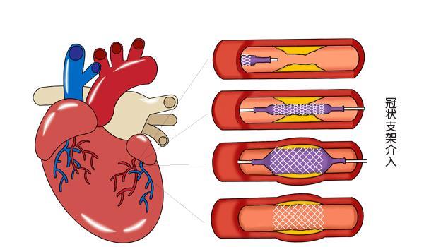 2023年心脏支架最新价格,关于心脏支架的最新价格论述